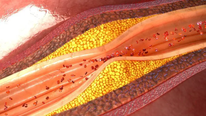 風(fēng)口 | 冠脈鈣化&ldquo;終結(jié)者&rdquo;&mdash;&mdash;血管內(nèi)沖擊波